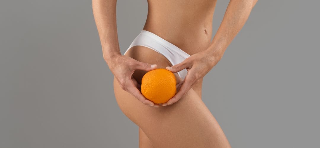 femme tenant une orange pour symboliser la cellulite